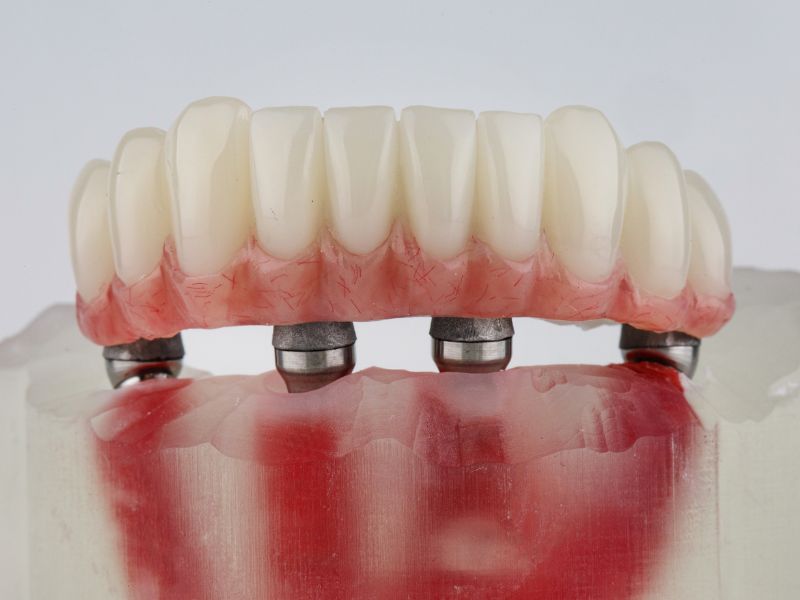 Implantes Dentários